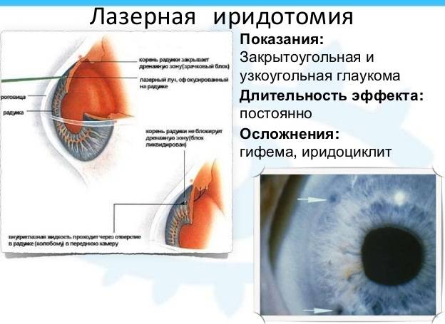 Лазерная иридэктомия: преимущества и недостатки - "здоровое око"