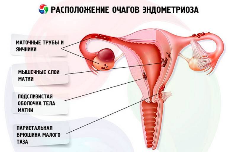 Эндометриоз при климаксе: симптомы и лечение состояния