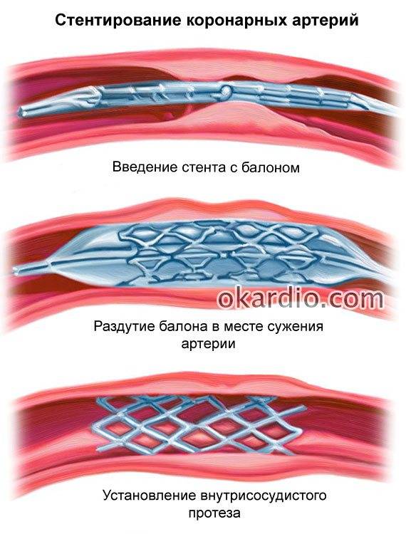 Замена стентов. Стентирование коронарных артерий схема. Коронарная ангиопластика и стентирование. Баллонная ангиопластика и стентирование. Баллонная ангиопластика сосудов сердца.