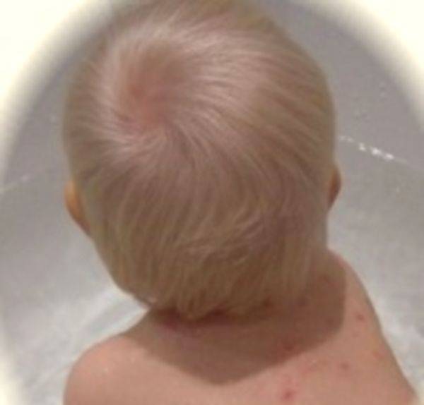 Стригущий лишай на голове у ребенка: фото начальной стадии, признаки, лечение микроспории