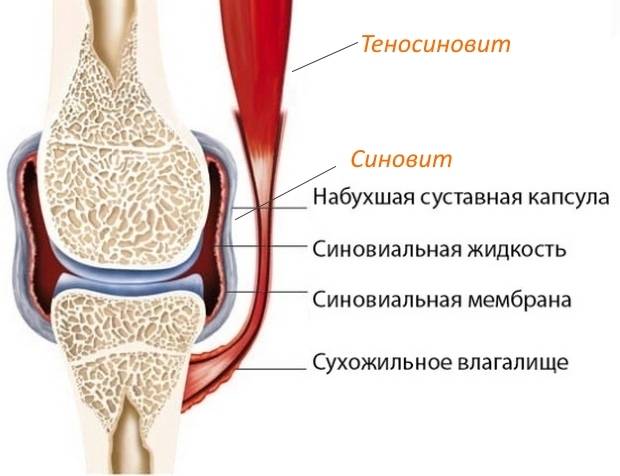 5 причин боли под коленом сзади при сгибании и разгибании: как избавиться, методы лечения
