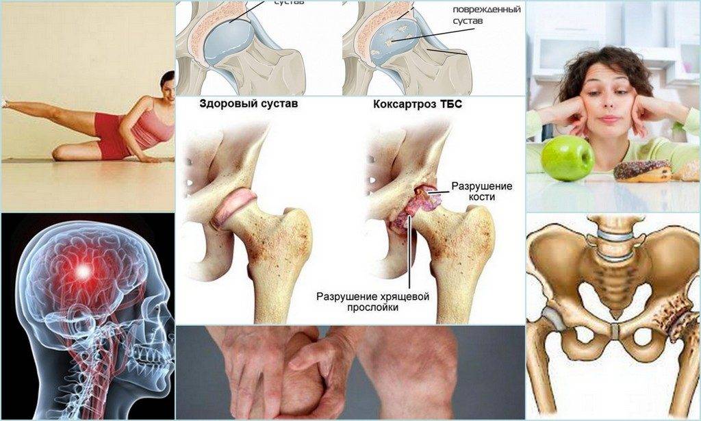 Артрит тазобедренного сустава - симптомы и методы лечения. упражнения при артрите таза