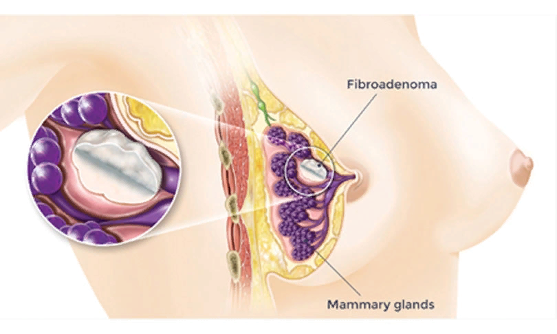 Может ли фиброаденома перерасти в рак груди и чем еще опасна для женщин данная патология молочной железы