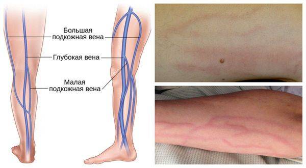 Симптомы тромбофлебита ног у женщин грибок лечение