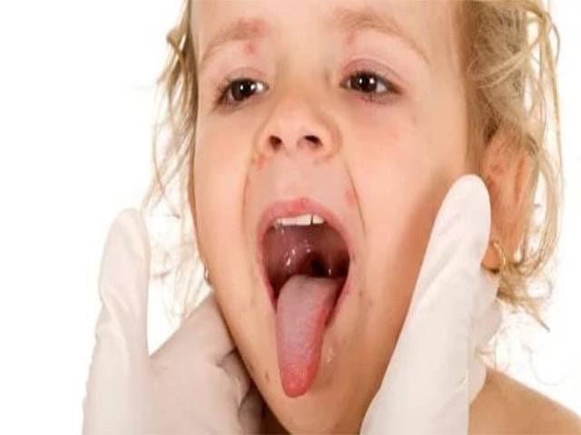 Ангина в горле у ребенка (30 фото): как выглядит фолликулярная, лакунарная, вирусная и катаральная и грибковая, бактериальная и стрептококковая формы, налет на миндалинах в начальной стадии