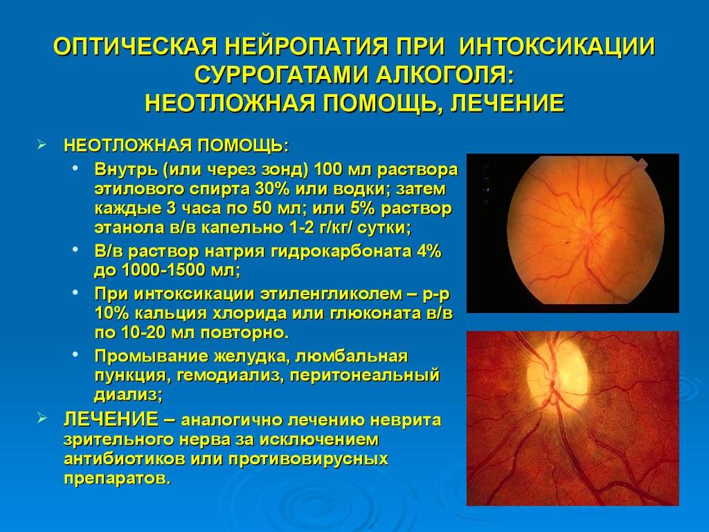 Нейропатия зрительных. Задняя ишемическая нейропатия зрительного нерва. Ишемическая нейрооптикопатия глаза. Задняя ишемическая нейропатия глазное дно. Ишемическая нейропатия оптического нерва.
