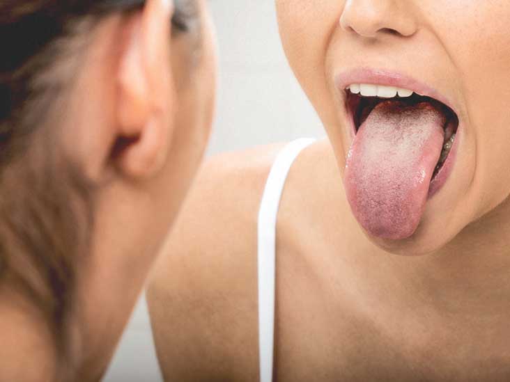 Кандидоз полости рта у взрослых и детей: симптомы и лечение