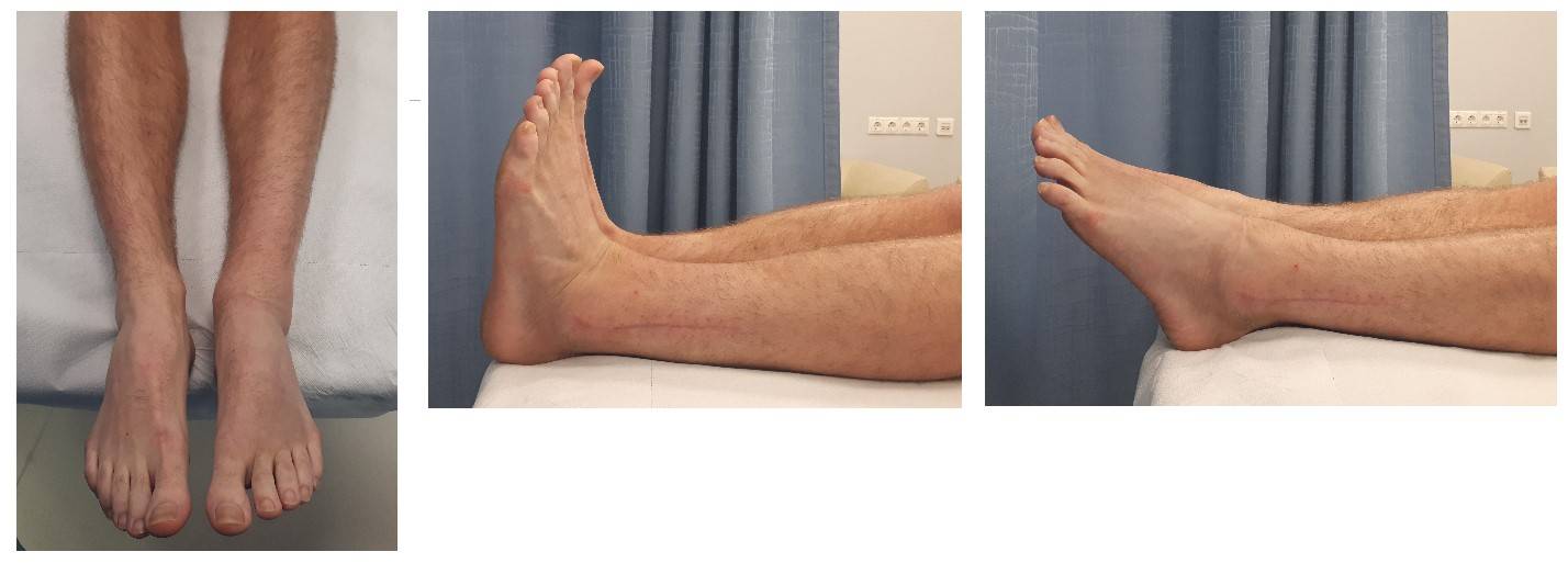 Признаки перелома пальца на ноге – лечение, сколько срастается