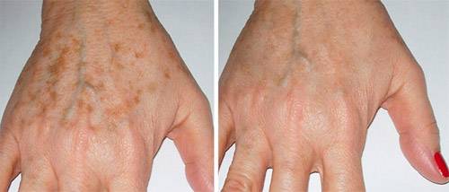 Коричневые пигментные отметины: причины появления на коже рук, способы эффективного удаления пятен