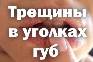 Трещины в уголках губ причины и у взрослого и ребенка