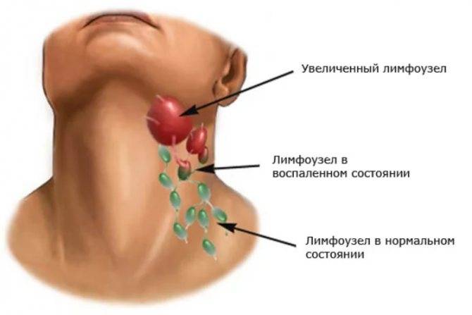 Антибиотики при воспалении лимфоузлов на шее: какие таблетки пить