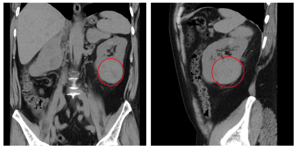 Магнитно-резонансная томография почки опухоль. Кт снимки опухоль почки. На кт видно опухоль