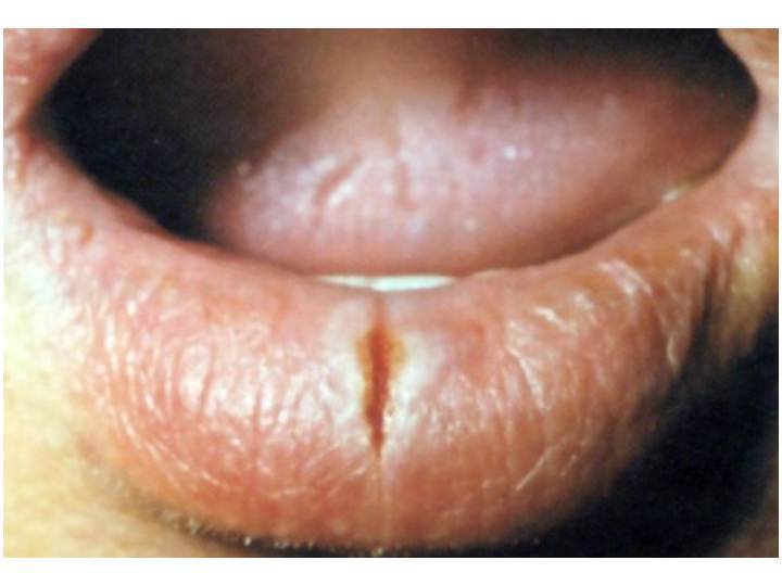 Какого витамина не хватает если трескаются губы (уголки губ)?