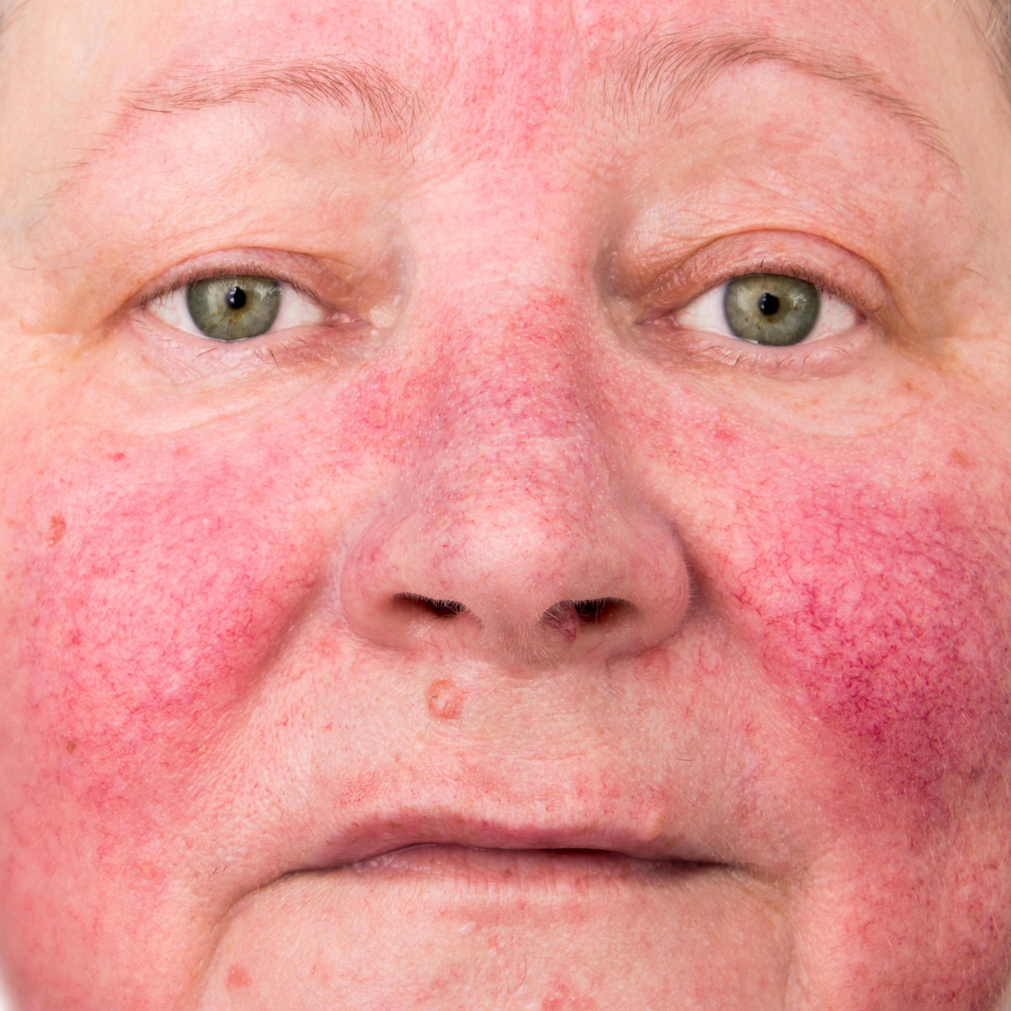 Аллергия на щеках у взрослого: причины, симптомы, лечение