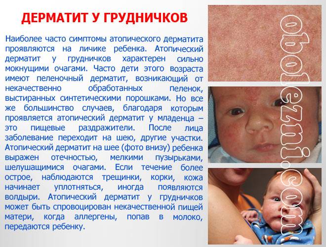 Пеленочный (памперсный, грибковый) дерматит у детей, лечение и симптомы на фото