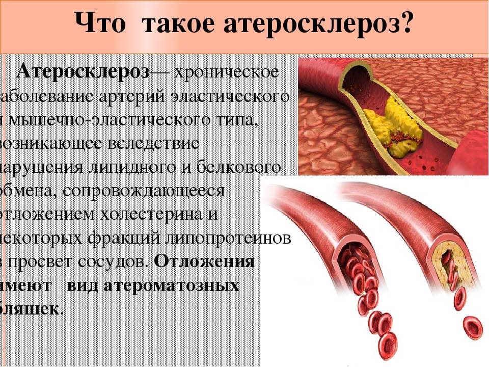 Лечение атеросклероза артерии. Причины атеросклероза сосудов. Атеросклеротическая болезнь.
