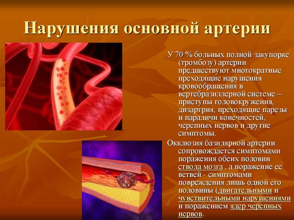 Тромбоз артерий мозга. Основной артерии. Окклюзия базилярной артерии. Тромбоз основной артерии.