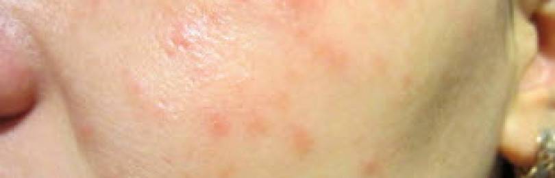 Аллергия на коже - красные пятна чешутся, лечение мазью - kardiobit.ru