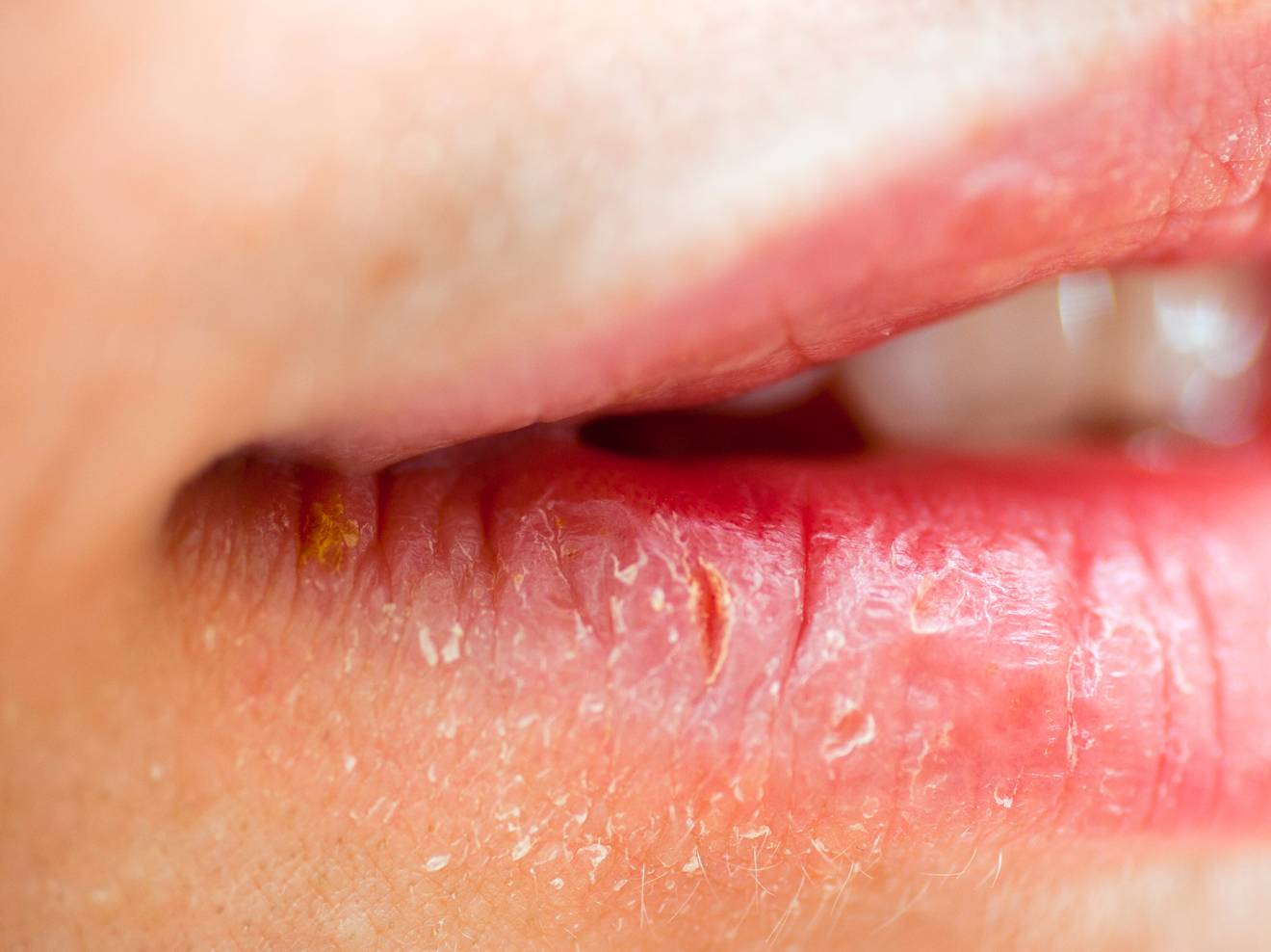 Трещины в уголках губ: причины и лечение народными средствами