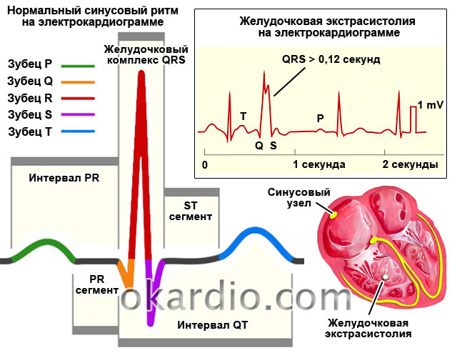 Экстрасистолы 4. ЭКГ при желудочковой экстрасистолии. Экстрасистола желудочков на ЭКГ. Экстрасистолическая аритмия на ЭКГ. Желудочковые экстрасистолы на ЭКГ.