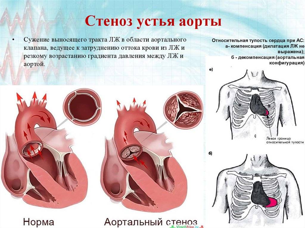 Стеноз аортального клапана у детей