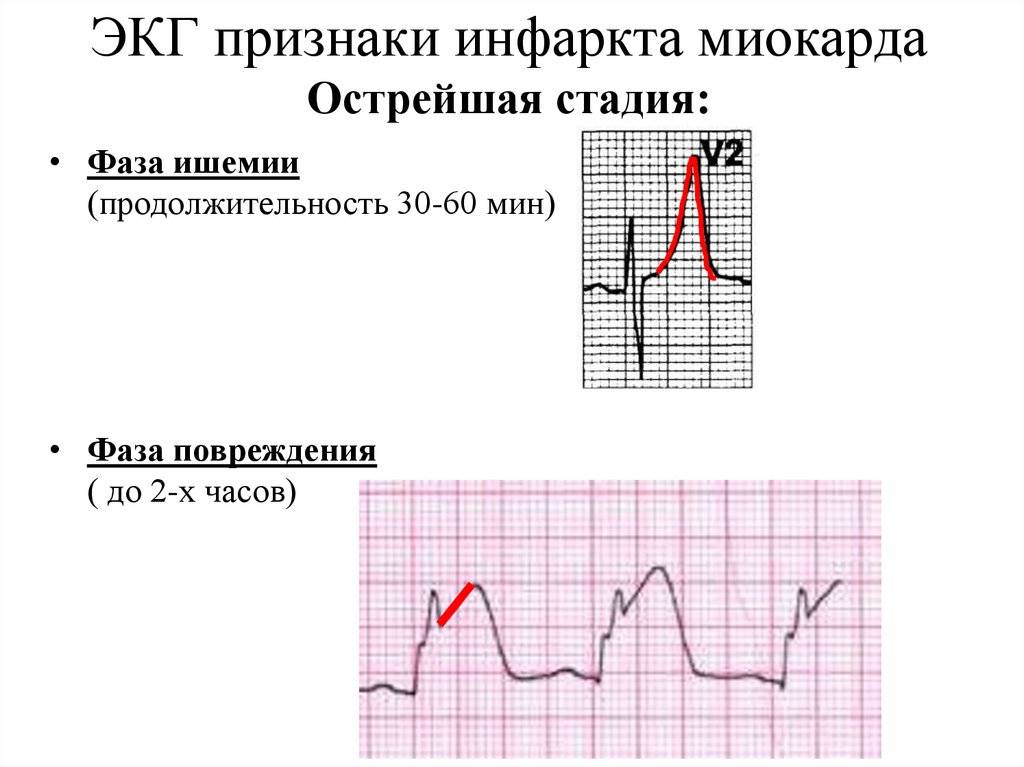 Может ли кардиограмма не показать инфаркт - терапевтonline