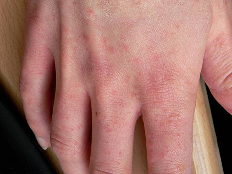 Кожные заболевания рук