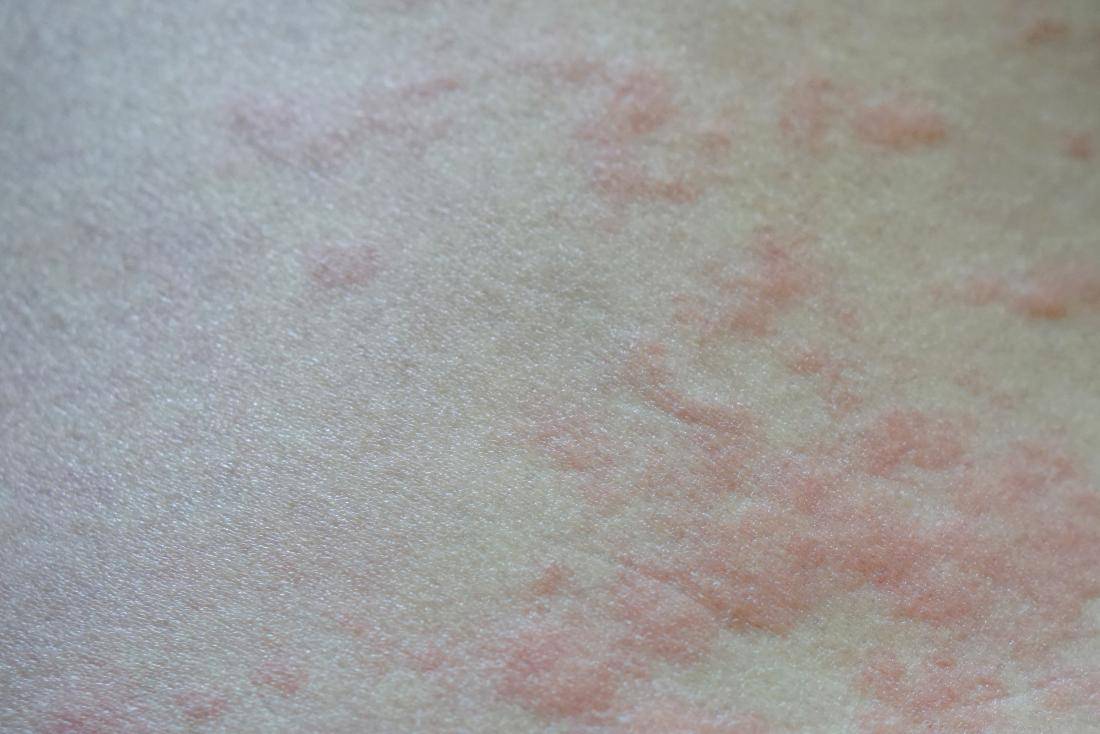 Аллергическая сыпь: симптомы, причины, фото, лечение | жизнь без аллергии
как выглядит сыпь при аллергии? | жизнь без аллергии