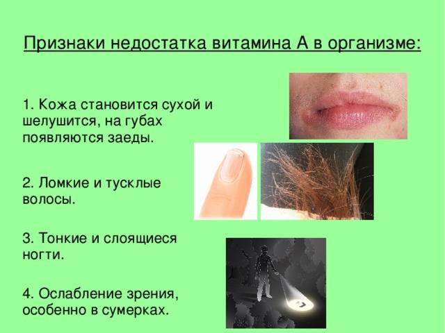 Чем лечить заеды в уголках губ