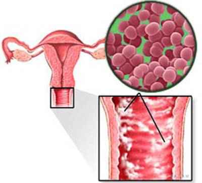 Атрофический вагинит (постменопаузный кольпит) у женщин: симптомы, лечение и прочие особенности