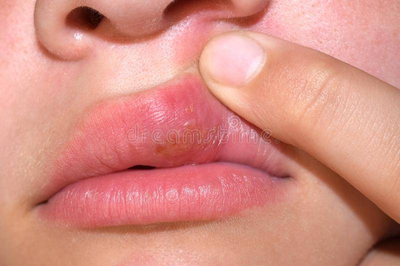 Сухость во рту при коронавирусе: чем полоскать рот при коронавирусе