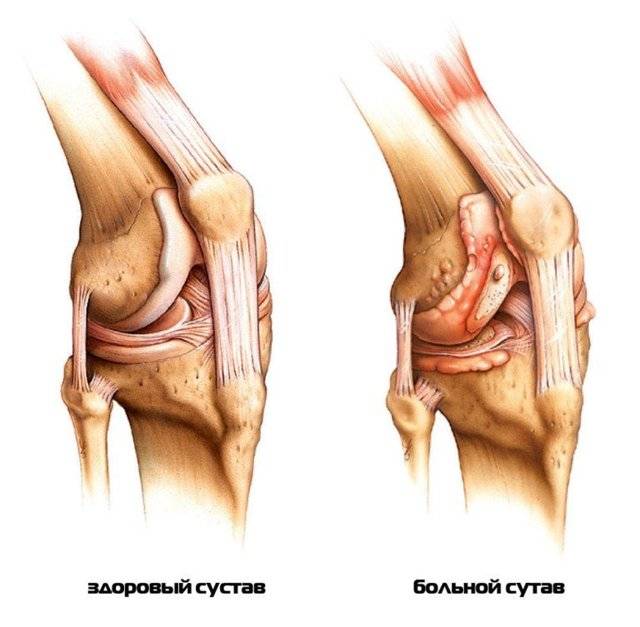 Болит колено с внутренней стороны: причины боли внутри коленного сустава