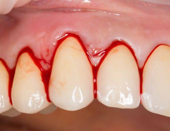 Кровоточат десны при чистке зубов: лечение у взрослых и детей
