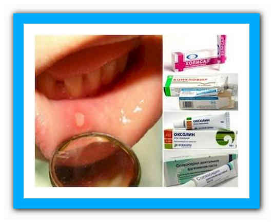 Болят губы будто обветрены. лечение витаминами, аптечными мазями, уход — medists.ru