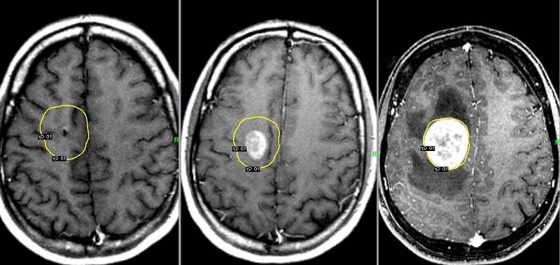 Поддаются ли лечению метастазы в головном мозге