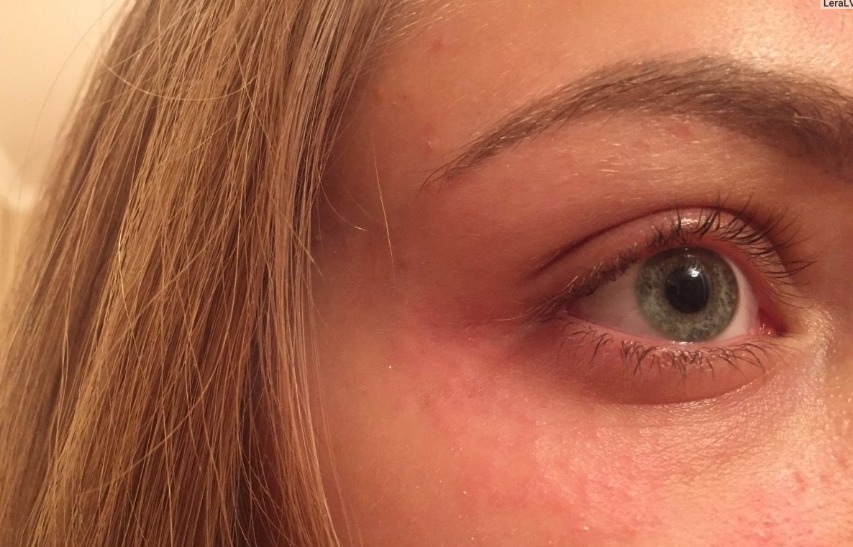 Как лечить аллергию на глазах — простые и действенные советы