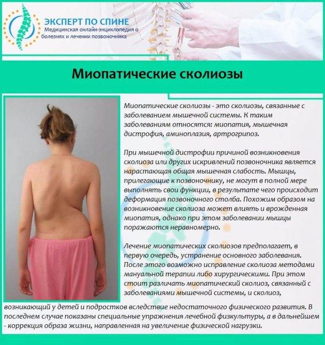 Правосторонний сколиоз грудного отдела позвоночника: лечение и профилактика
