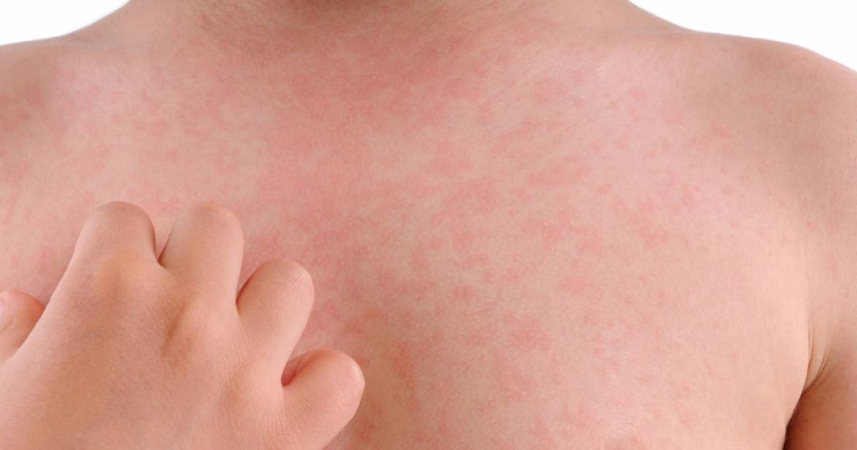Виды аллергии на коже, какие бывают высыпания на фото