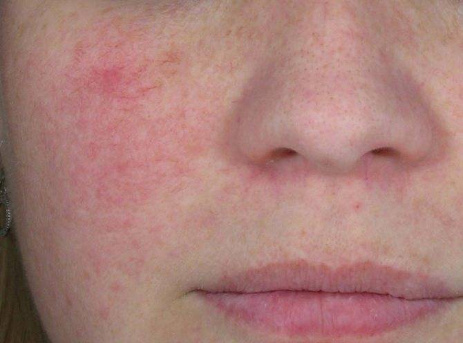 Красные щеки у взрослого • аллергия и аллергические реакции