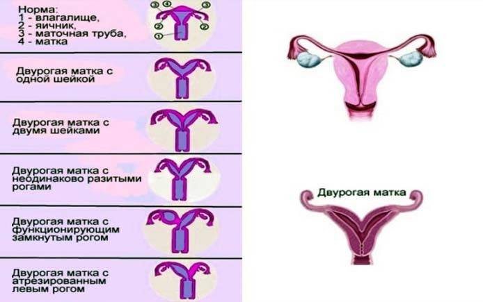 Гипоплазия матки - степени, признаки, причины, лечение
