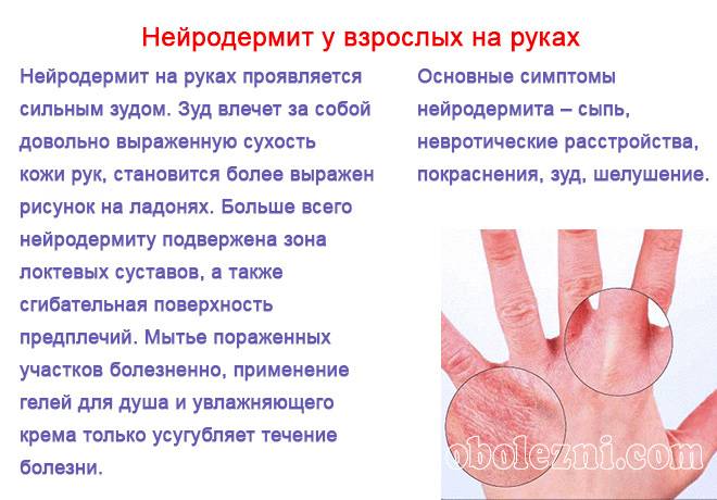 Нейродермит – фото, симптомы и лечение на руках