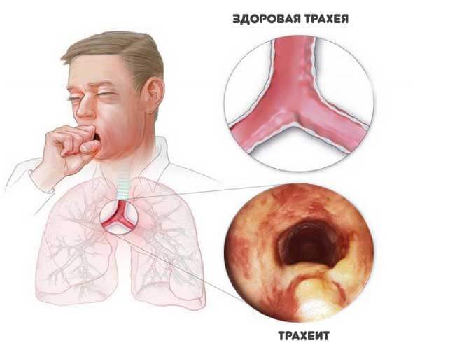 Почему возникает першение в горле и сухой кашель, и какое требуется лечение?