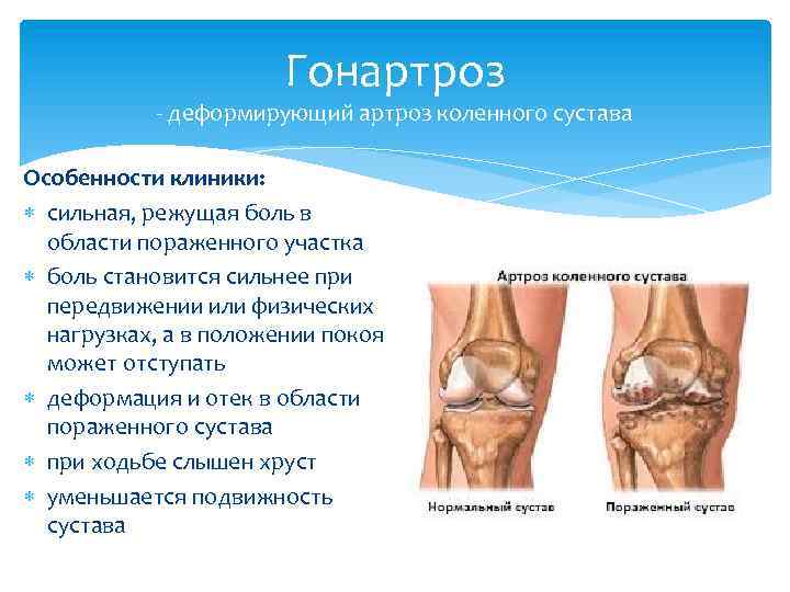 Остеоартроз что это такое как лечить. Клинические проявления гонартроз. Гонартроз коленного сустава этиология. Деформирующий остеоартроз 1 степени коленного. Деформирующий артроз коленного сустава стадии.