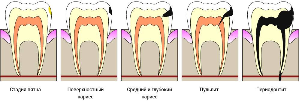 Прикорневой кариес что делать — зубы
