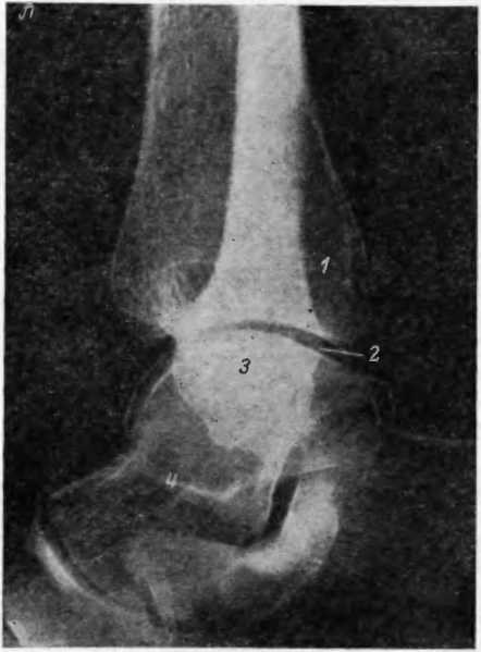 Рентген голеностопного сустава: описание и норма, где сделать в двух проекциях, признаки разрыва синдесмоза, повреждение связок