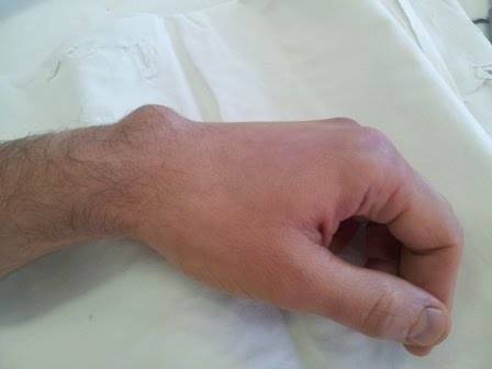 Гигрома на пальце руки - причины возникновения, симптомы, диагностика, методы лечения и удаления