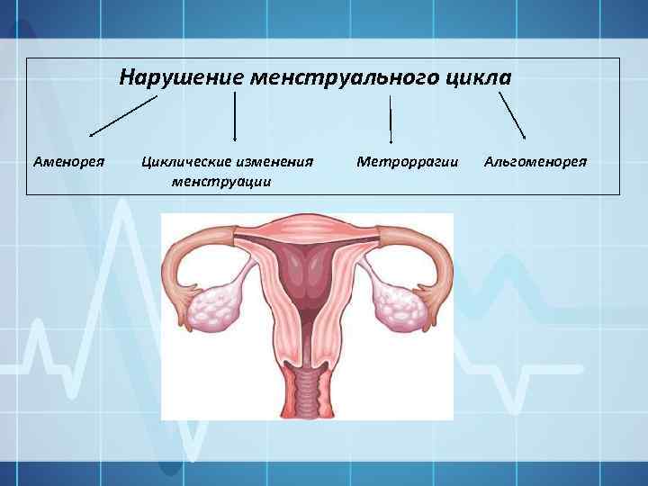 Нарушение менструационного цикла: причины, лечение