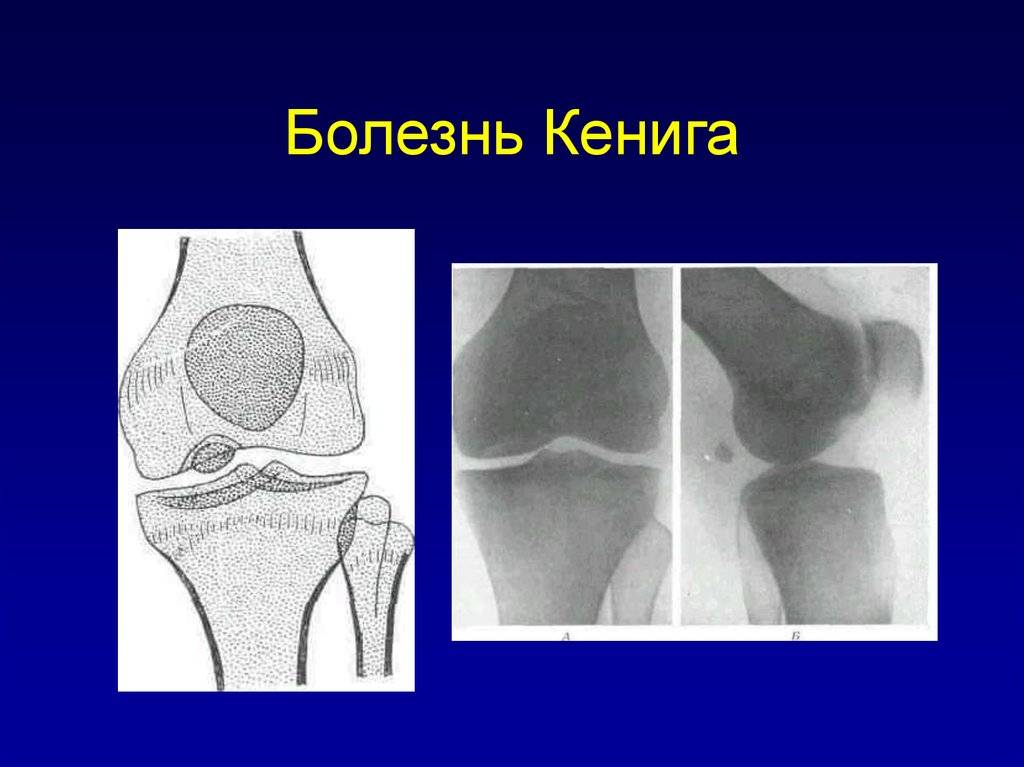 Болезнь кенига: причины и лечение рассекающего остеохондрита коленного сустава