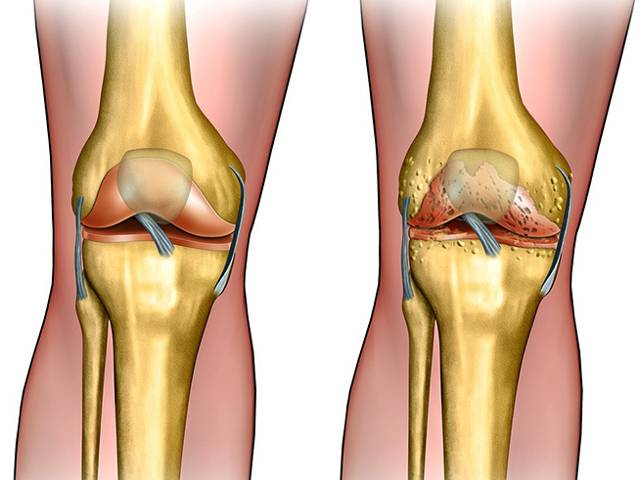 Лечение артроза коленного сустава 3 степени без операции