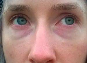 Синяки под глазами у детей: причины появления темных синих кругов под глазами у ребенка / mama66.ru